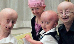 Çocuklukta Yaşlanan Hayatlar: Progeria Hastalığı