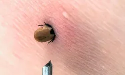 Kene Isırığı Can Aldı!