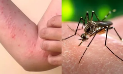 Chikungunya Virüsü Nedir? Belirtileri, Aşı Durumu ve Bulaşma Yolları