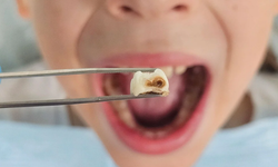 Çürük Dişler Artık Kendini Onaracak! Bilim İnsanları Ağız Sağlığında Devrim Yarattı